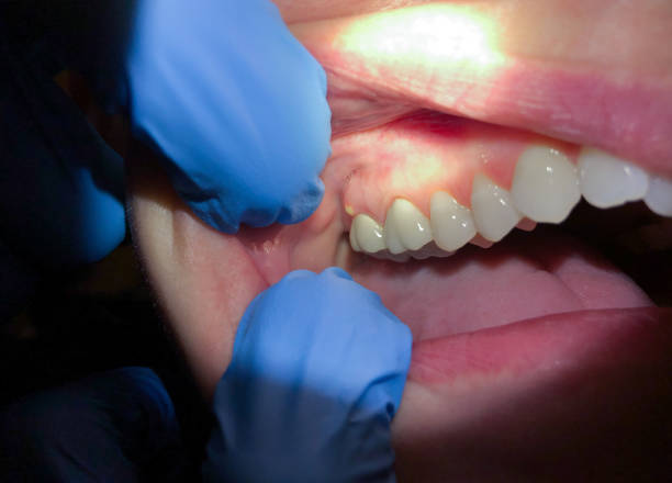 Best Dentist for Tooth Abscess  in Wrightstown, WI